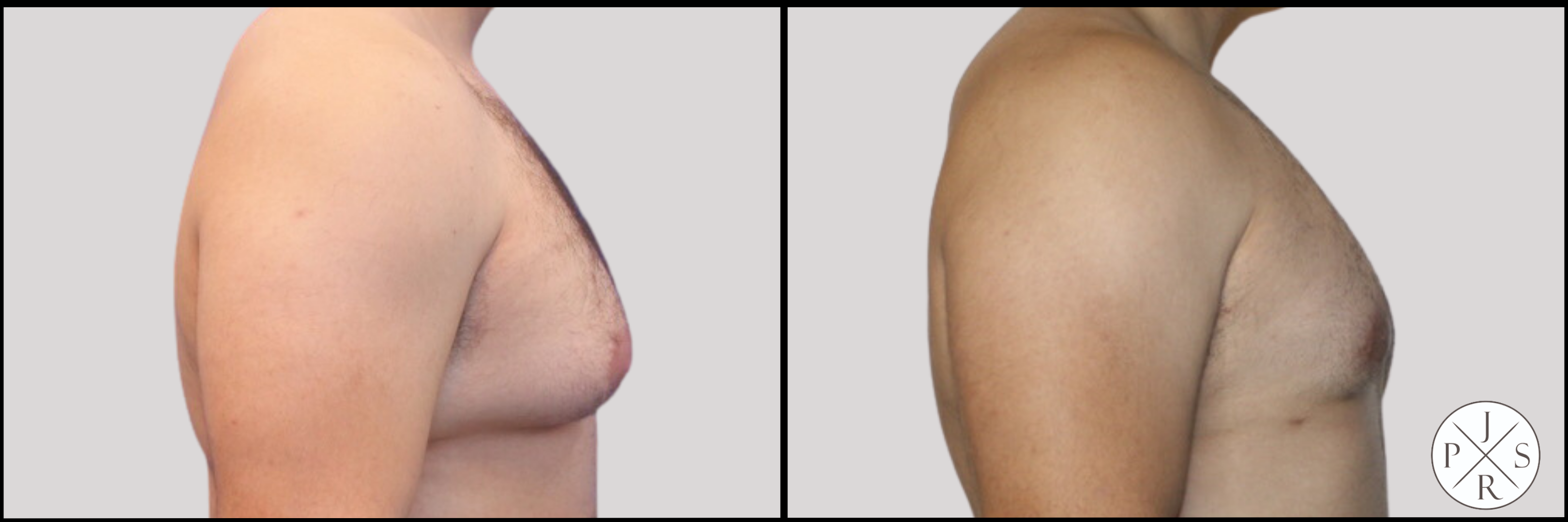 Gynaecomastia Before & After Image